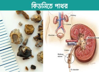কেন কিডনিতে পাথর হয় ? এর প্রতিকার কি ?