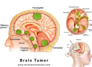 ব্রেন টিউমারের লক্ষণ ও প্রতিকার brain tumor