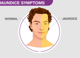 গরমের দিনে আর এক বিপদের নাম জন্ডিস
