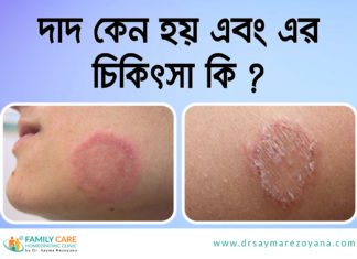 দাদ এর কারণ, চিকিৎসা ও দাদ হলে কি খাওয়া নিষেধ Dermatophytosis