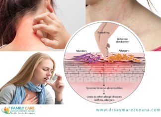 অ্যালার্জির কারণ ও প্রতিকার অ্যালার্জি থেকে মুক্তির উপায়ঃ
