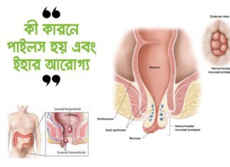 কী কারনে পাইলস হয় এবং ইহার আরোগ্য