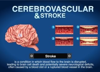 Exploring the Link Between Vascular Cerebral Disease and Stroke Link between Vascular Cerebral Disease and Stroke