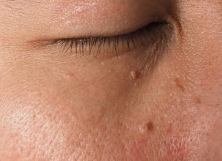 আঁচিল দূর করার ঘরোয়া উপায় ও জনপ্রিয় ১০টি সমাধান